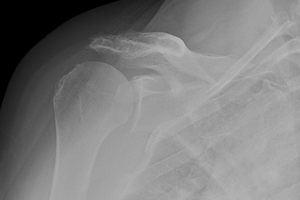 x-ray before surgery demonstrating shoulder arthritis associated with an irreparable rotator cuff tear