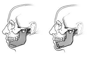 Chin surgery