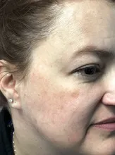 Why Do I Have These Brown Spots on My Face?