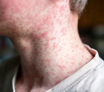 Measles Facts and Vaccine Information