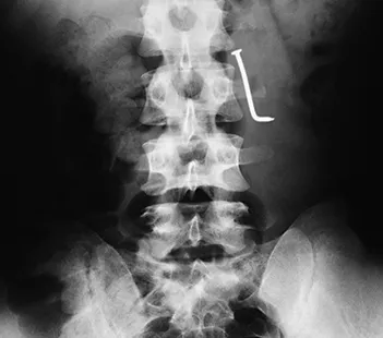 Strangest Things Doctors Have Seen